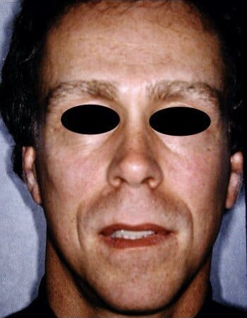 After Image: Facelift - front