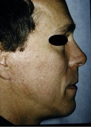 After Image: Facelift - right-side