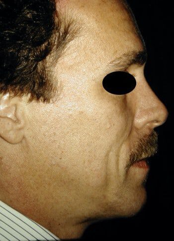 Before Image: Facelift - right-side