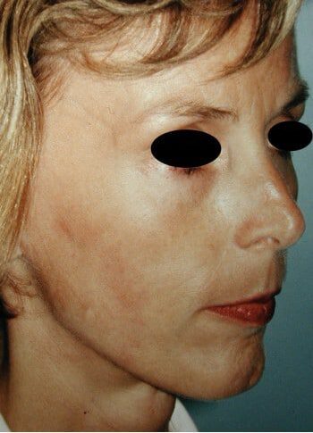 After Image: Facelift - right-front-oblique