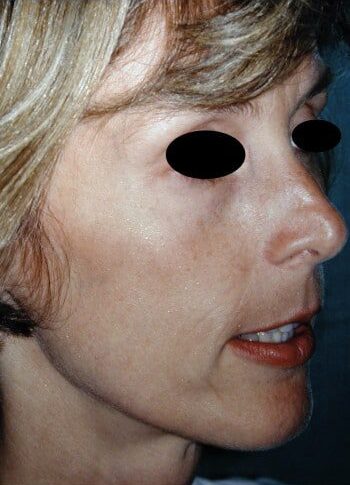 Before Image: Facelift - right-front-oblique