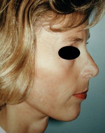 After Image: Facelift - right-side