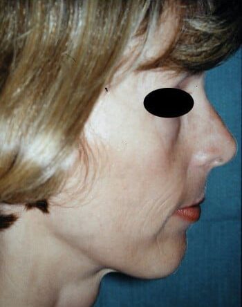 Before Image: Facelift - right-side