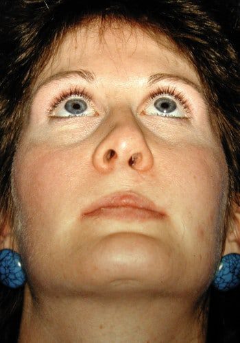 Before Image: Cleft Rhinoplasty - front