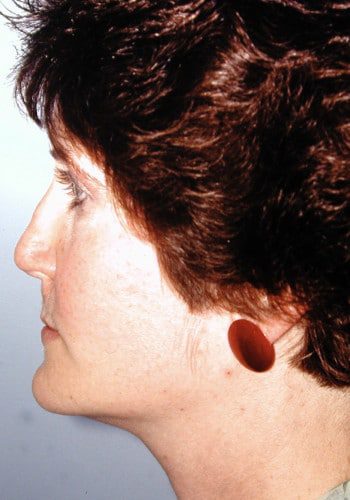 After Image: Cleft Rhinoplasty - left-side