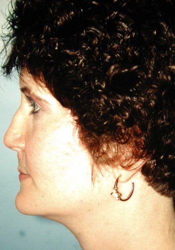 Before Image: Cleft Rhinoplasty - left-side