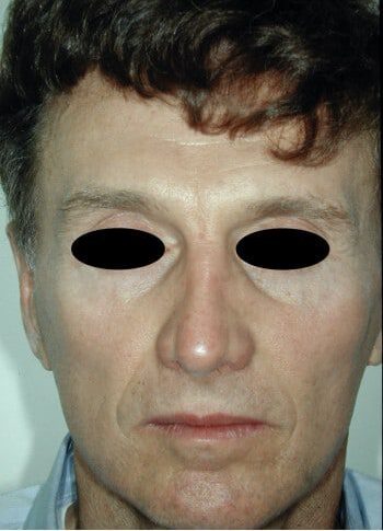 After Image: Browlift - front