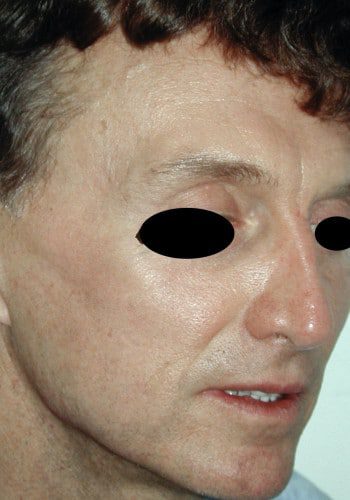 After Image: Browlift - right-front-oblique