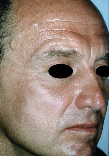 Before Image: Browlift - right-front-oblique