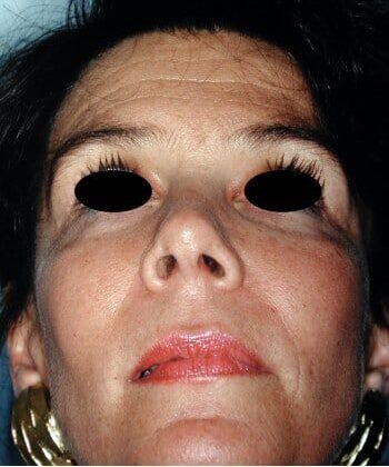 After Image: Facial Bone Augmentation - front