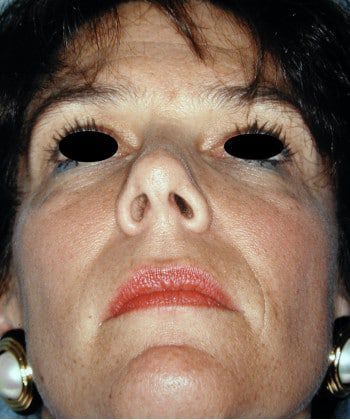 Before Image: Facial Bone Augmentation - front