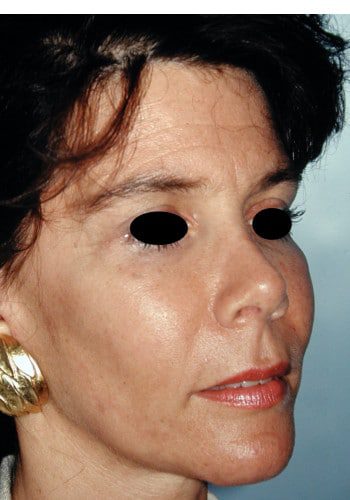 After Image: Facial Bone Augmentation - right-front-oblique
