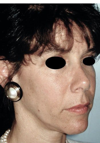 Before Image: Facial Bone Augmentation - right-front-oblique