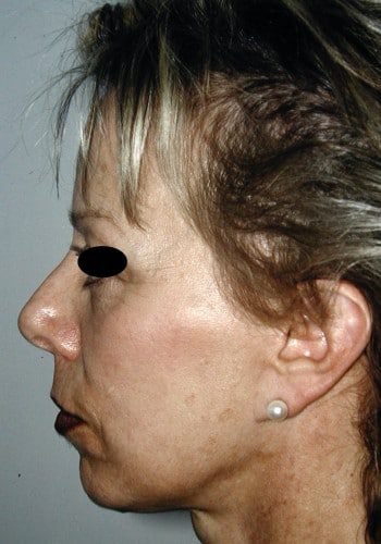 After Image: Browlift, Blepharoplasty, Facelift #3 - left-side
