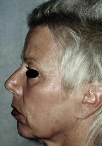 Before Image: Browlift, Blepharoplasty, Facelift #3 - left-side