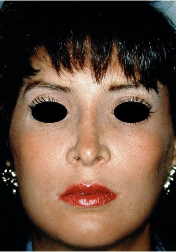 After Image: Facial Bone Augmentation - front