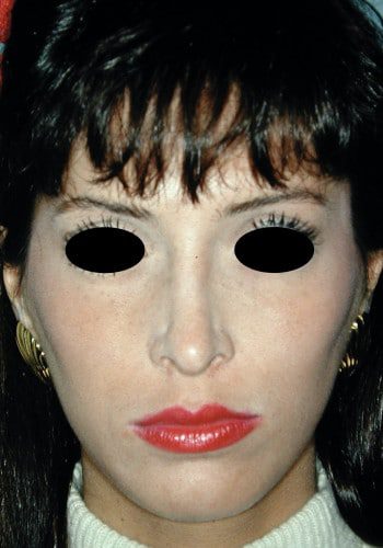 Before Image: Facial Bone Augmentation - front