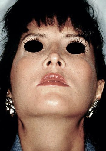 After Image: Facial Bone Augmentation - front