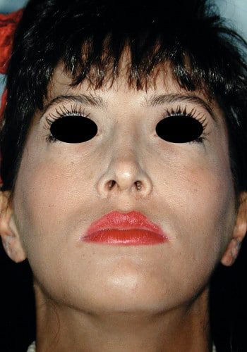 Before Image: Facial Bone Augmentation - front