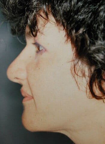After Image: Rhinoplasty, Genioplasty - left-side