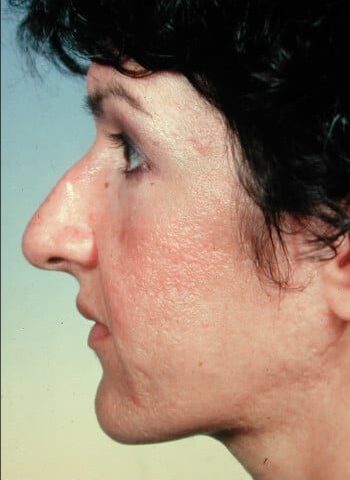 Before Image: Rhinoplasty, Genioplasty - left-side