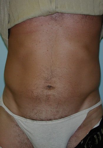 After Image: Liposuction - front