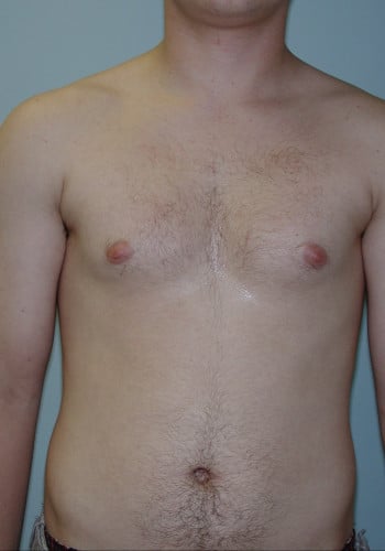 Before Image: Liposuction - front