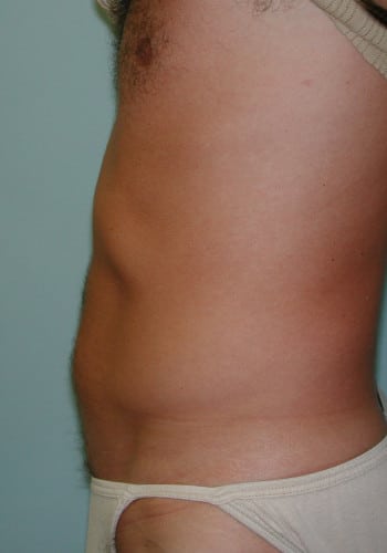 After Image: Liposuction - left-side