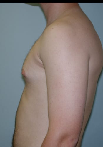 Before Image: Liposuction - left-side