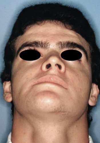 Before Image: Maxillofacial - front