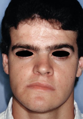 Before Image: Maxillofacial - front