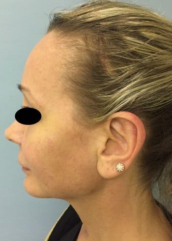 After Image: Facial Bone Augmentation; Genioplasty; Browlift - left-side