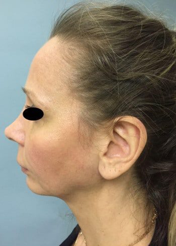 Before Image: Facial Bone Augmentation; Genioplasty; Browlift - left-side