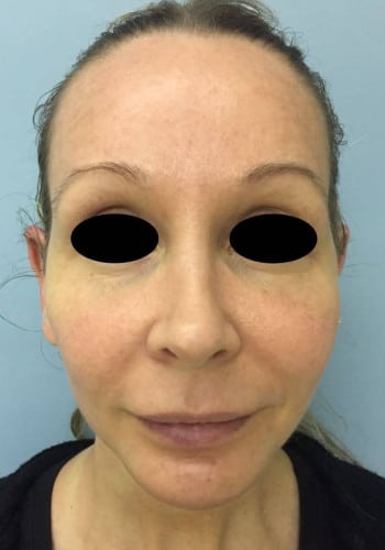 After Image: Facial Bone Augmentation; Genioplasty; Browlift - front