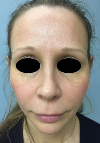 Before Image: Facial Bone Augmentation; Genioplasty; Browlift - front