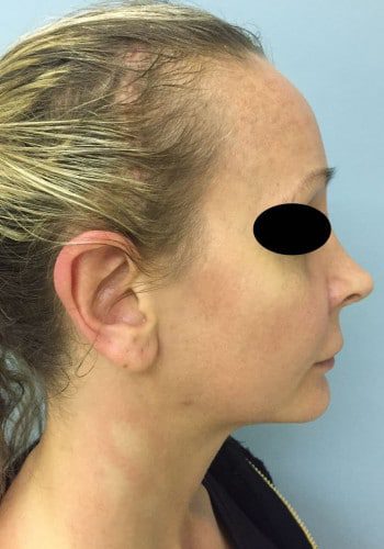 After Image: Facial Bone Augmentation; Genioplasty; Browlift - right-side