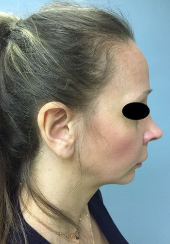 Before Image: Facial Bone Augmentation; Genioplasty; Browlift - right-side
