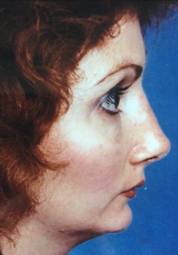 After Image: Genioplasty, Rhinoplasty - right-side