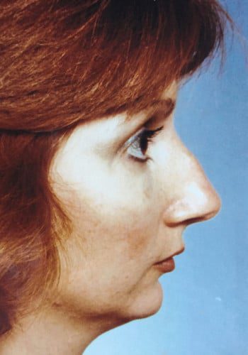 Before Image: Genioplasty, Rhinoplasty - right-side