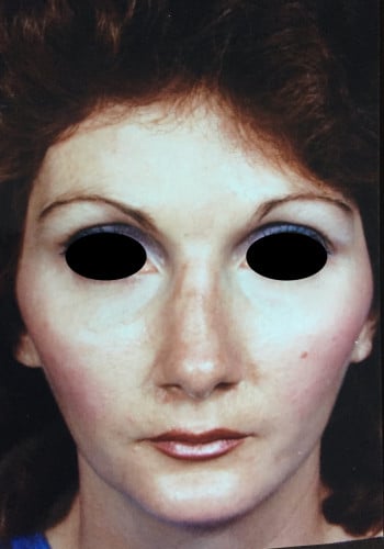 After Image: Genioplasty, Rhinoplasty - front