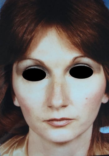 Before Image: Genioplasty, Rhinoplasty - front
