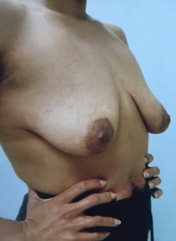 Before Image: Mastopexy, Breast Augmentation - right-front-oblique