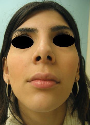 After Image: Rhinoplasty - front