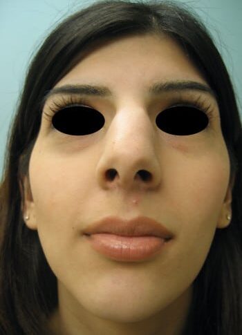 Before Image: Rhinoplasty - front