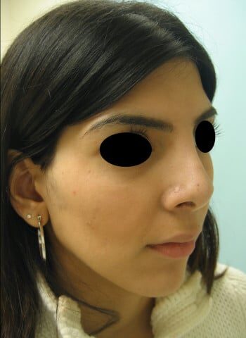 After Image: Rhinoplasty - right-front-oblique
