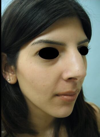 Before Image: Rhinoplasty - right-front-oblique