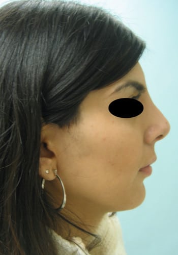 After Image: Rhinoplasty - right-side