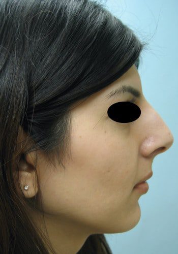 Before Image: Rhinoplasty - right-side