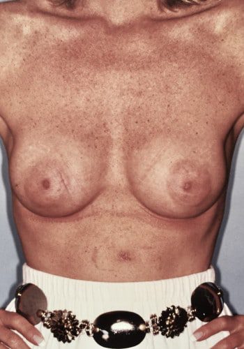 After Image: Breast Augmentation - front