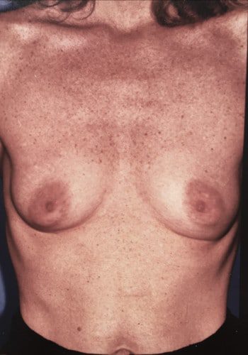 Before Image: Breast Augmentation - front